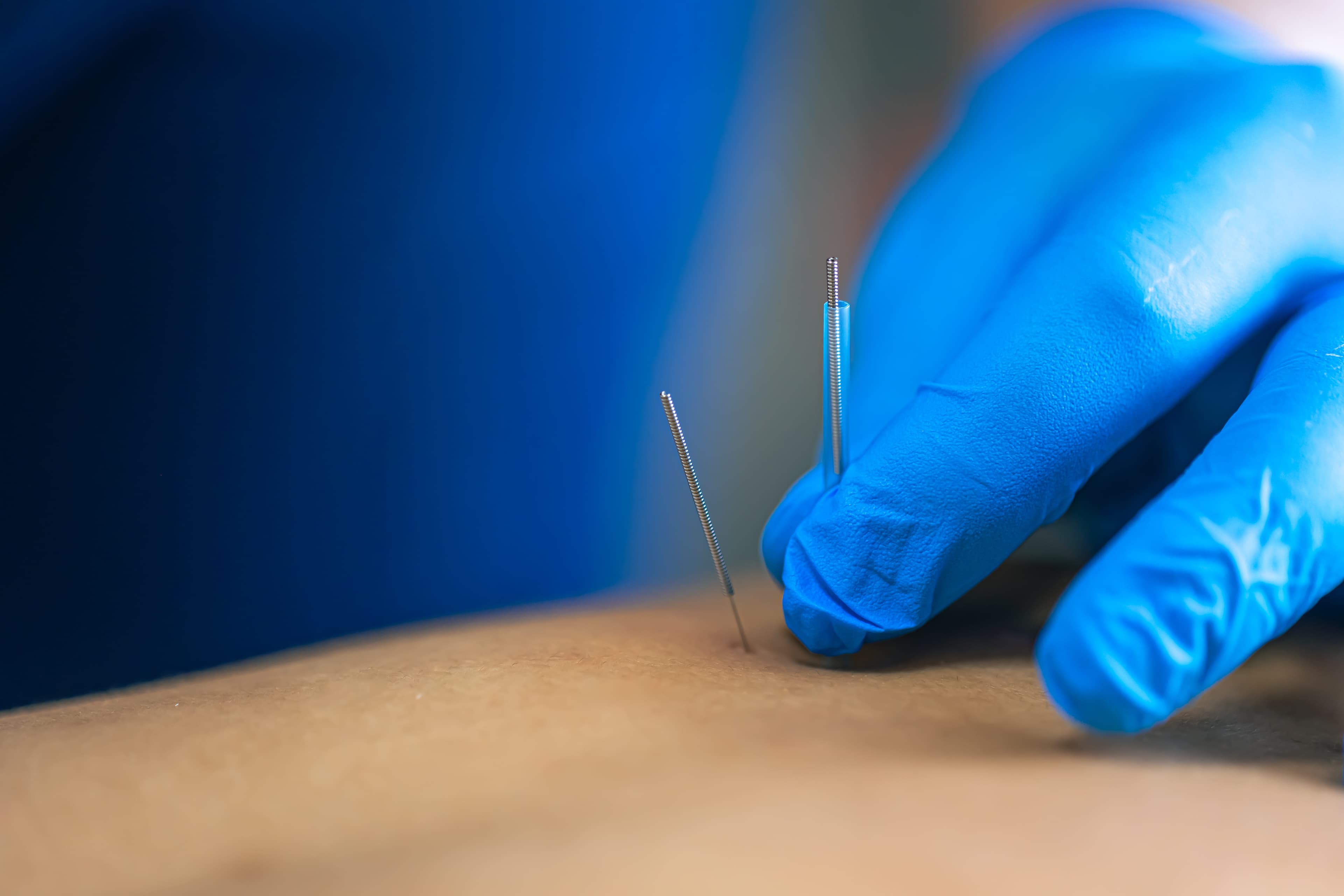 Advanced Dry Needling: Moving Beyond Foundational Techniques
